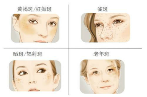 如何祛曬斑？有哪些簡單實(shí)用的辦法？
